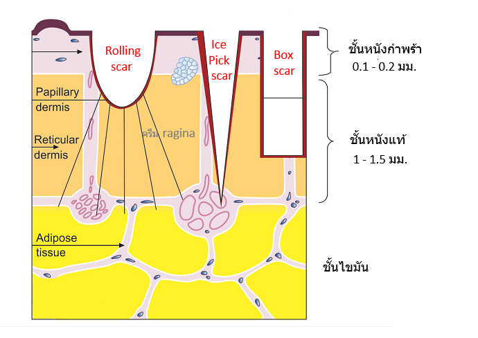 รักษาหลุมสิว