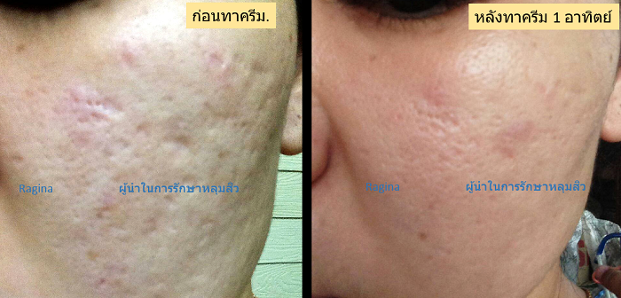 ครีมหลุมสิว ครีมรักษาหลุมสิว หลุมสิว รักษาหลุมสิว