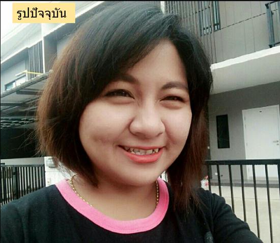 รักษาหลุมสิว