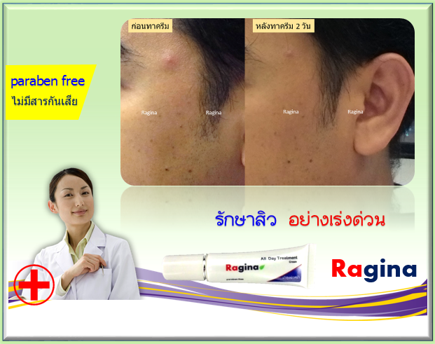 ครีมรักษาสิว สิวอุดตัน สิวอักเสบ