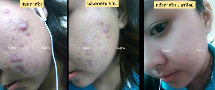 ครีมหลุมสิว ครีมรักษาหลุมสิว หลุมสิว รักษาหลุมสิว