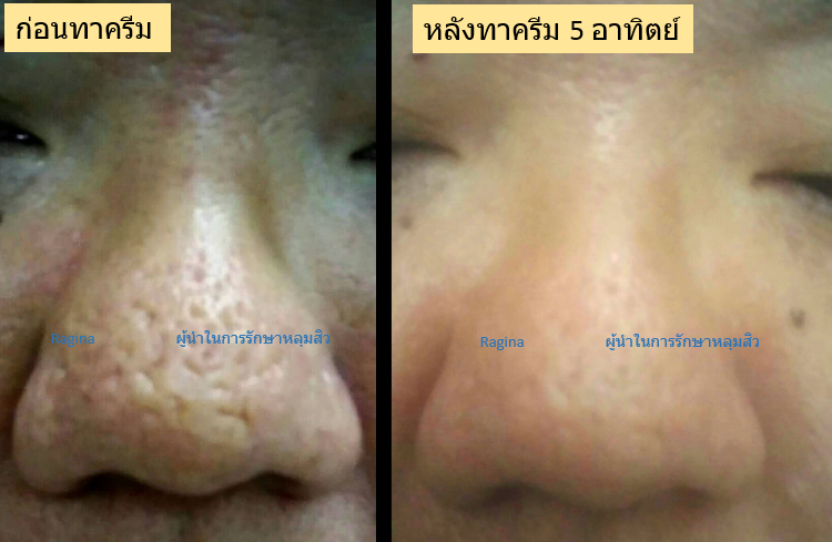 ครีมหลุมสิว ครีมรักษาหลุมสิว หลุมสิว รักษาหลุมสิว